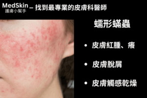 蠕形蟎蟲